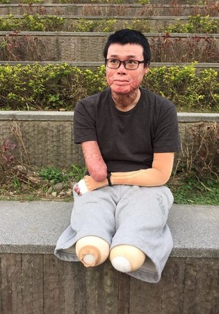 八仙塵爆傷者「雙腿+右手截肢」存活率僅5%！他淚述「爸媽每天笑著報時」背後原因讓大家哭了！