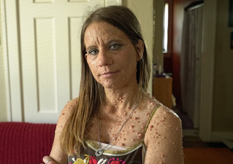 她「全身長滿6000顆腫瘤」被笑癩蝦蟆沒人敢接近，如今「成功移除臉部肉瘤」現平滑美肌！