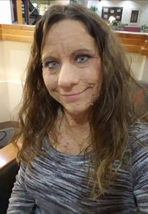 她「全身長滿6000顆腫瘤」被笑癩蝦蟆沒人敢接近，如今「成功移除臉部肉瘤」現平滑美肌！