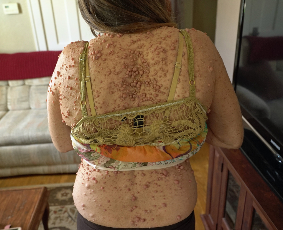 她「全身長滿6000顆腫瘤」被笑癩蝦蟆沒人敢接近，如今「成功移除臉部肉瘤」現平滑美肌！