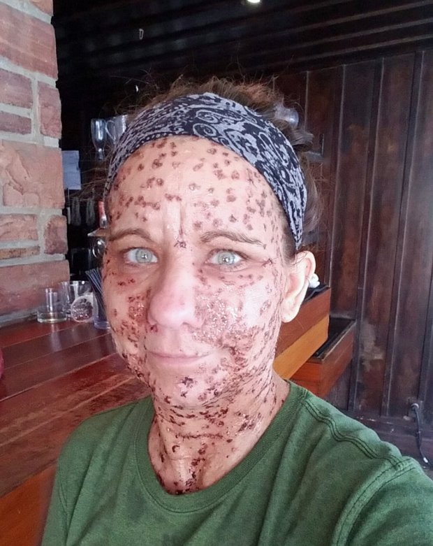 她「全身長滿6000顆腫瘤」被笑癩蝦蟆沒人敢接近，如今「成功移除臉部肉瘤」現平滑美肌！