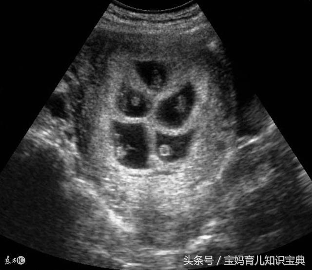 孕婦產檢「懷了6胞胎」樂壞家人！沒想到生產那天，醫生一見「孩子們性別」狂喊：堪稱奇蹟！