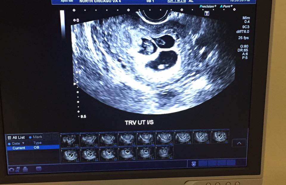 丈夫剛離開她確定懷孕，沒想到產檢時「醫師的話」讓她當場痛哭流涕！