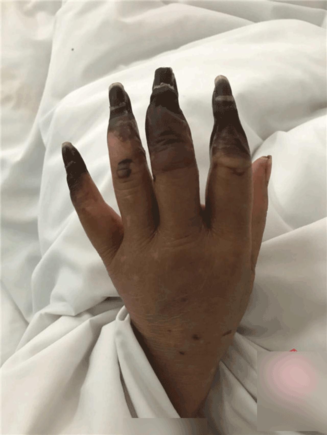 家庭主婦打掃完後竟「8根指頭焦黑」慘變枯枝！醫生看了直搖頭嘆：她太粗心了......
