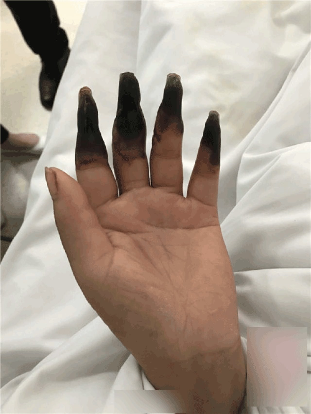 家庭主婦打掃完後竟「8根指頭焦黑」慘變枯枝！醫生看了直搖頭嘆：她太粗心了......