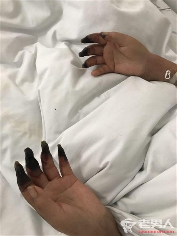 家庭主婦打掃完後竟「8根指頭焦黑」慘變枯枝！醫生看了直搖頭嘆：她太粗心了......