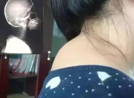 後方肩頸「突起1包」是因為太胖？不只不好看還會痛...簡單5招消除「富貴包」！