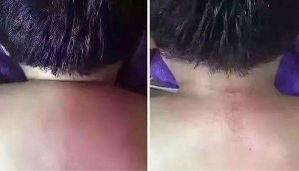 後方肩頸「突起1包」是因為太胖？不只不好看還會痛...簡單5招消除「富貴包」！