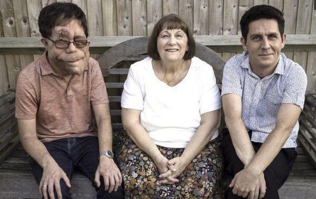 可愛雙胞胎人人羨，孰料「弟弟長大很英俊、哥哥卻變怪物」！最後結局竟「完全相反」讓人落淚...