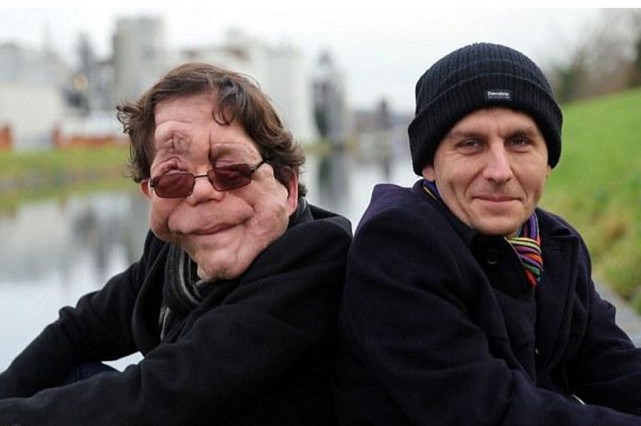 可愛雙胞胎人人羨，孰料「弟弟長大很英俊、哥哥卻變怪物」！最後結局竟「完全相反」讓人落淚...