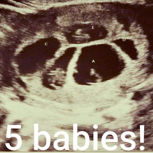 老婆「不孕2年」絕望放棄　半年後醫生一看「超音波畫面怪怪的」嚇傻：妳破紀錄了！