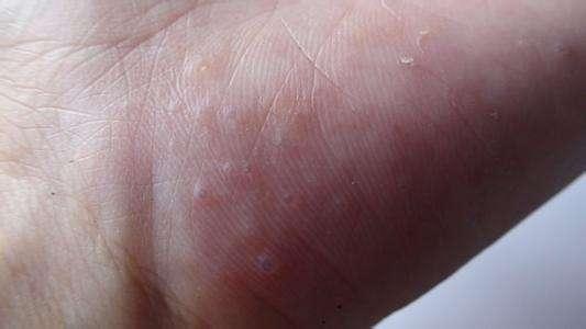 手上突然起「透明小水泡」，抓破後有少量液體流出，該怎麼辦？教你一招，很快就好！