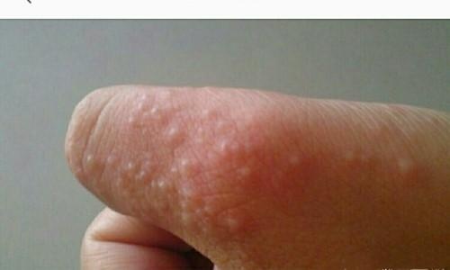 手上突然起「透明小水泡」，抓破後有少量液體流出，該怎麼辦？教你一招，很快就好！