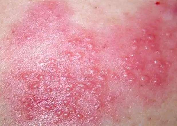 手上突然起「透明小水泡」，抓破後有少量液體流出，該怎麼辦？教你一招，很快就好！