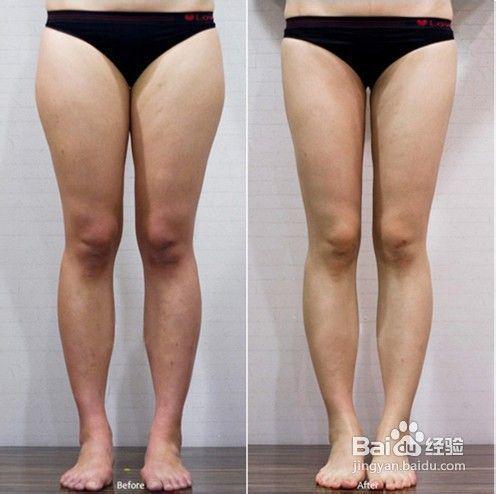 肌肉腿，大象腿看過來啦！她做了一個月蘿蔔腿不見了，腿又細又直
