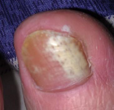 多半是「糖尿病足」的徵兆！雙腳一旦有4種表現要警惕：嚴重要截肢　教你4招「預防併發症」控制糖尿病