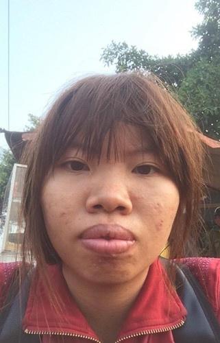 大逆襲！醜女「天生爆唇沒人敢娶」狠花43萬整形　1年後美翻「被封越南第一美女」爽嫁富二代
