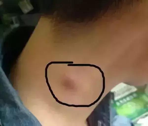 不痛不癢竟然患癌！脖子上出現「3種東西」注意了　趕快自查一下：說明癌細胞已醒
