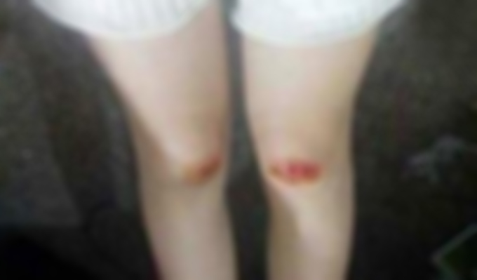 妻子出去逛街回來膝蓋就有淤青，老公起疑跟蹤，如遭雷擊！