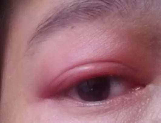 皮膚上出現3種症狀！你家蟎蟲已經「做窩」了     教你4個土辦法「蟎蟲消滅乾淨」