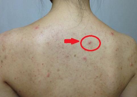 皮膚上出現3種症狀！你家蟎蟲已經「做窩」了     教你4個土辦法「蟎蟲消滅乾淨」
