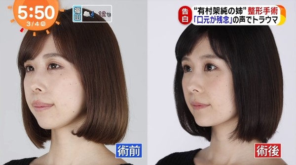 妹妹是超美女神！暴牙女星「被酸輸了好多截」 　砸100萬整形變「甜美大眼正妹」網驚：笑容好美
