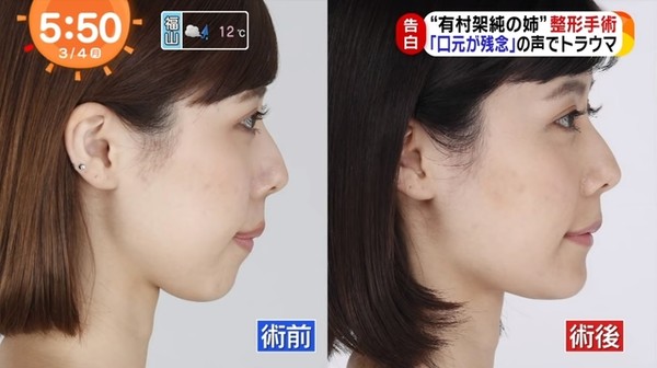 妹妹是超美女神！暴牙女星「被酸輸了好多截」 　砸100萬整形變「甜美大眼正妹」網驚：笑容好美