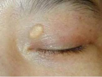 高血脂警訊！醫生警告：這3種食物讓你的血液黏如粥