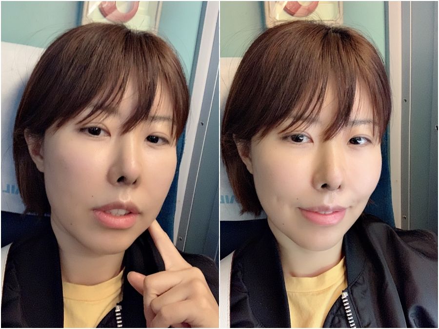 被笑4年豬鼻子！金老佛爺進廠維修「拆線看到鼻子哭了」　醫生安慰：「還要再做一次」