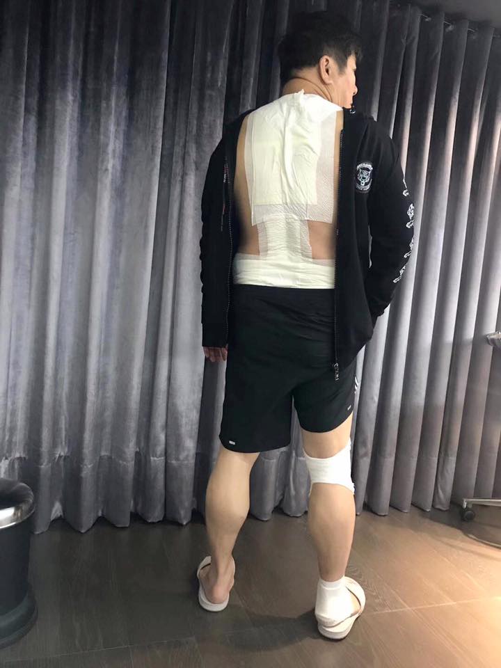 好敬業！66歲胡瓜「錄影重摔無法起身」緊急送醫　「背部貼滿藥膏」堅持繼續工作：不能辜負粉絲