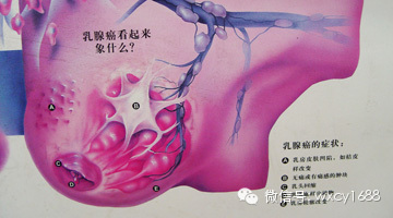 注意！專家示警：不要再買「這款胸罩」危害女人健康　嚴重會得乳腺癌