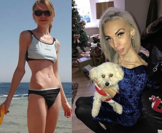 瘦到皮包骨！23歲姑娘厭食暴瘦至25公斤「走路都困難」     康復後逆襲：差點不敢認