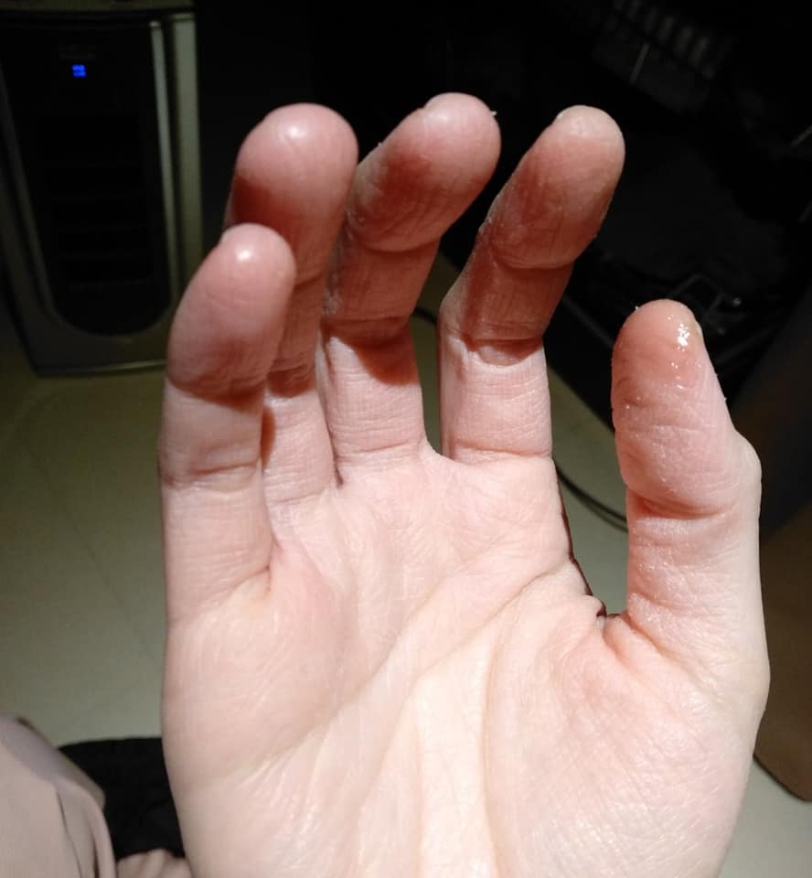 每天洗30次！護理師淚訴「手指乾到龜裂」一噴酒精就喊痛　曝心酸日常：「抱孩子的權利都沒了」