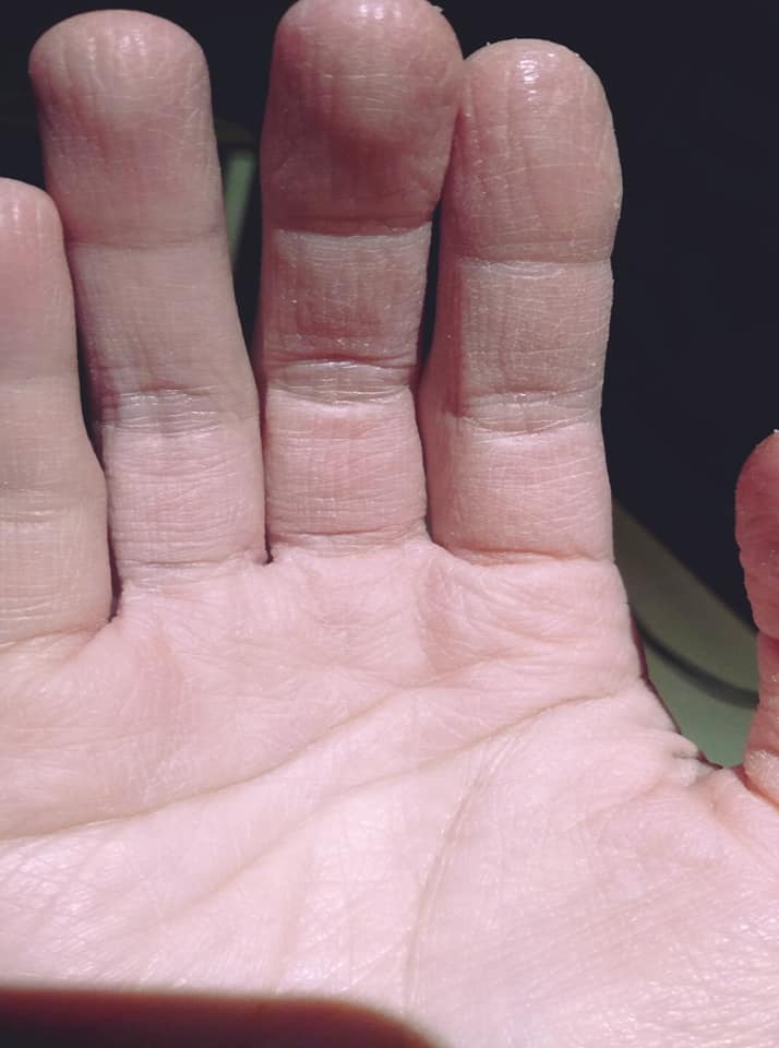 每天洗30次！護理師淚訴「手指乾到龜裂」一噴酒精就喊痛　曝心酸日常：「抱孩子的權利都沒了」