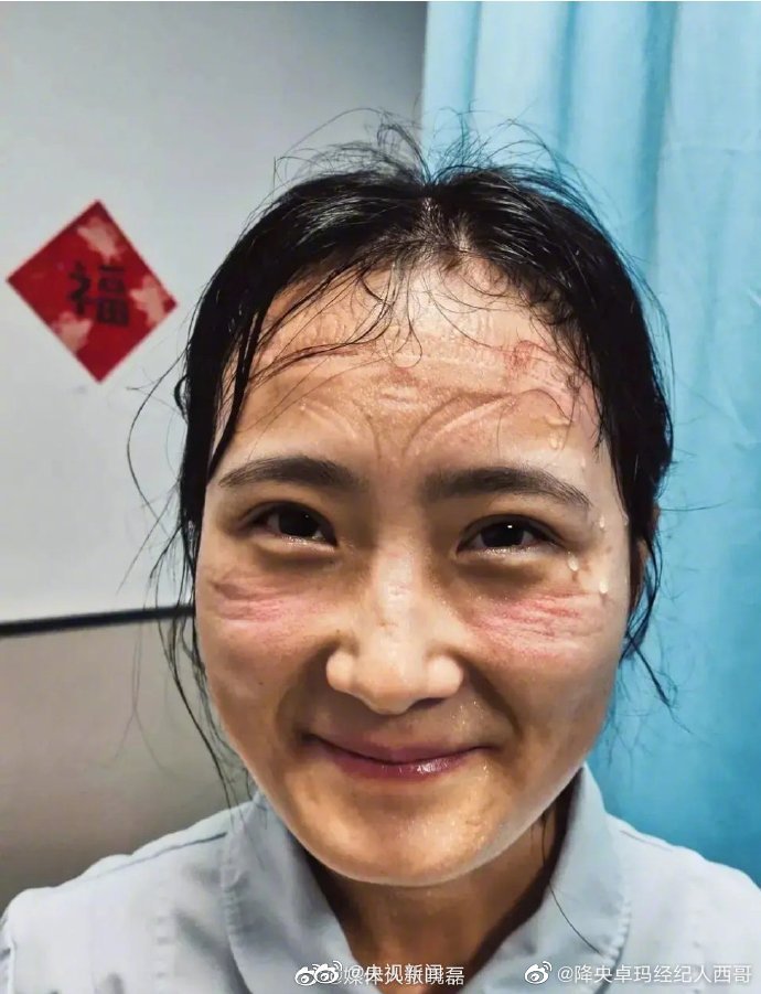 眼眶全是紅腫壓痕！義大利護士「PO出自拍照」狂吸70萬讚　淚訴6小時「不能喝水上廁所」網讚：妳是英雄