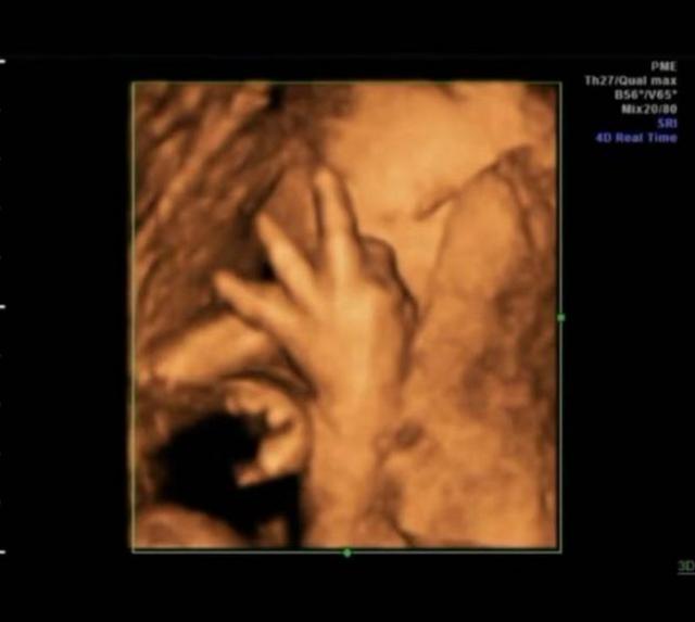 胎兒界的「數學天才」！孕婦照超音波發現胎兒在子宮裡「數數」超可愛     醫生：娘胎裡的學霸