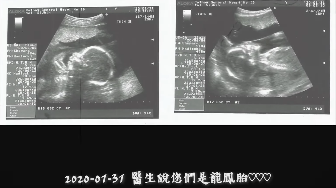 為母則強！媽媽懷龍鳳胎「孕肚大到變正方形」強忍雙倍辛苦　撐到最後「終於見到寶寶」哽咽：值得了