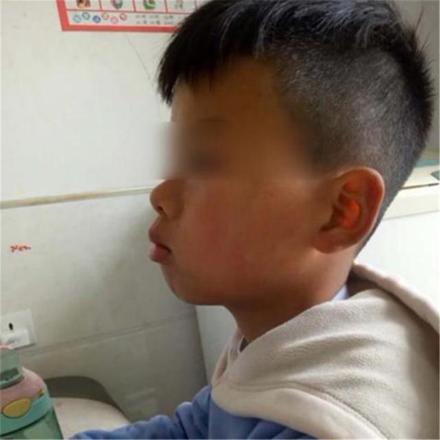 小時候是校草！兒子長大臉型「越來越像大猩猩」媽媽苦笑：長歪了 　朋友提醒「才知不對勁」醫生：該早點來