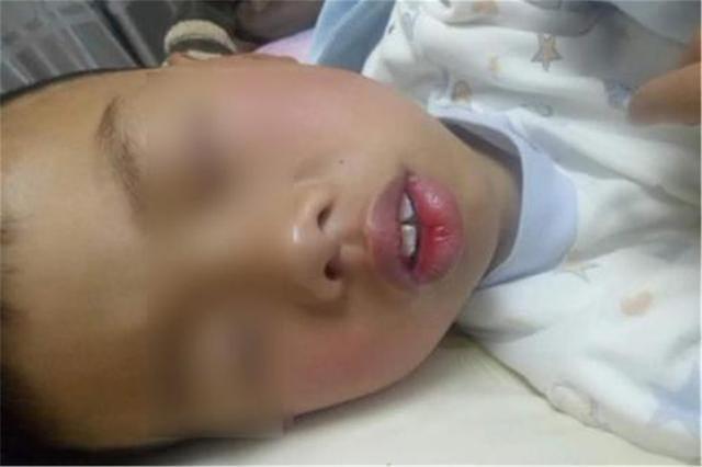 小時候是校草！兒子長大臉型「越來越像大猩猩」媽媽苦笑：長歪了 　朋友提醒「才知不對勁」醫生：該早點來
