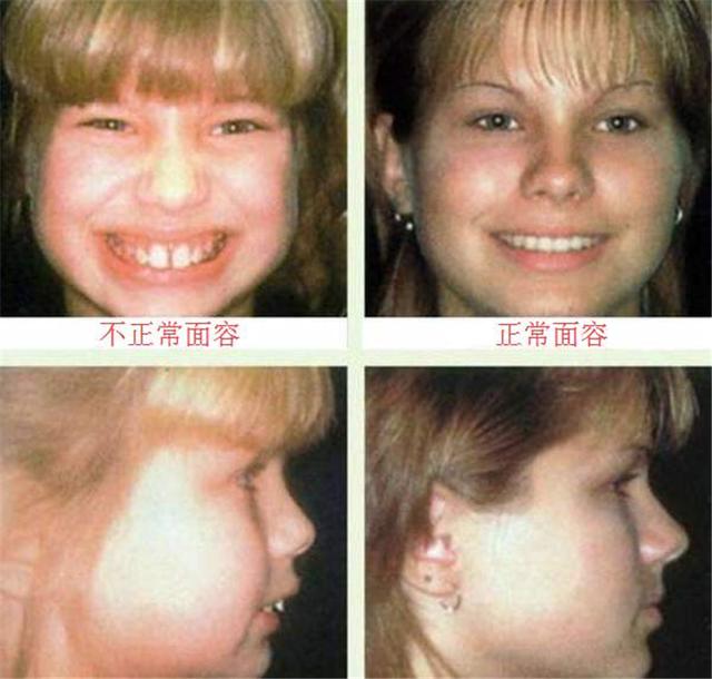 小時候是校草！兒子長大臉型「越來越像大猩猩」媽媽苦笑：長歪了 　朋友提醒「才知不對勁」醫生：該早點來