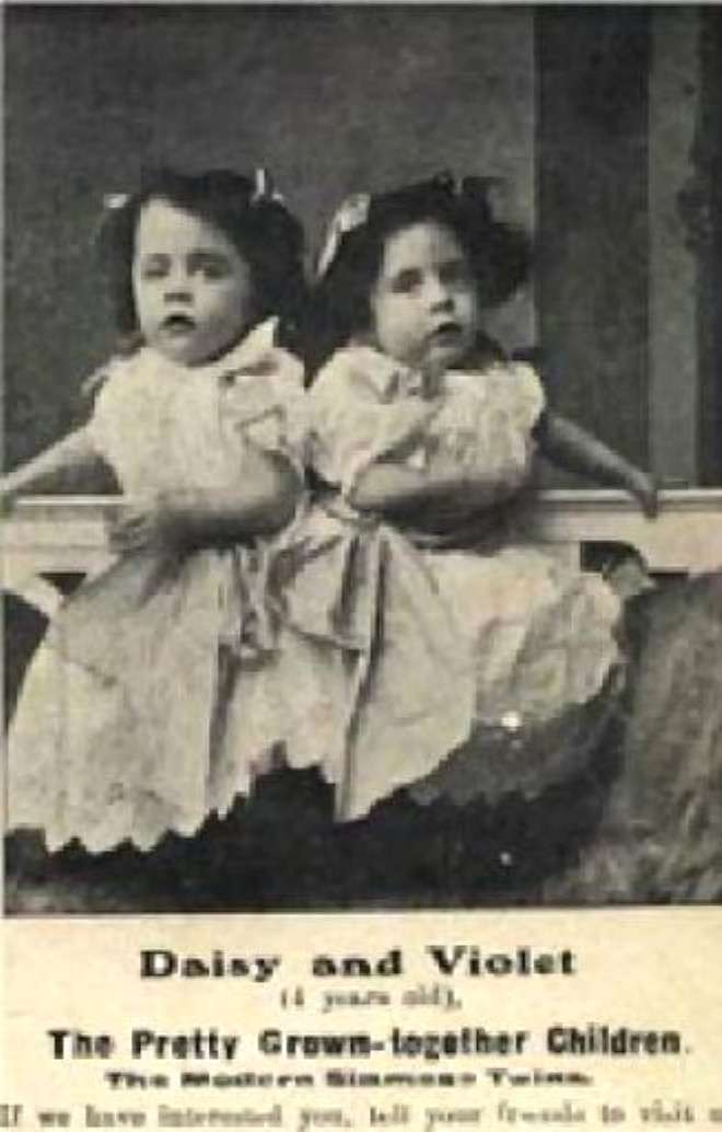 手腳沒共用！《驕女》演員被念「連體亂演」委屈落淚　真實連體姊妹「愛上有婦之夫」感情路讓人不捨