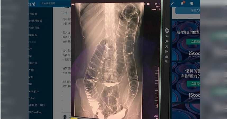 腹部全塞滿!佩甄工作壓力大「內部長東西了」:用手就能摸到