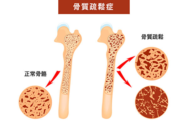 驚人研究！柑橘不只維生素C豐富 一天4顆還能大降骨鬆風險92％