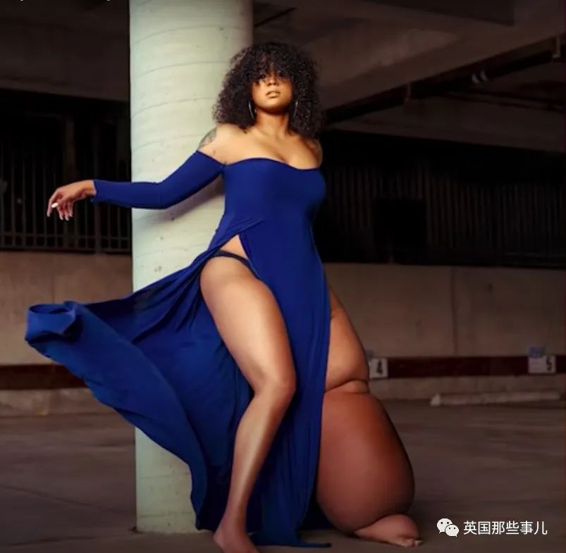被人當怪物不敢出門！天生一條腿「比腰還粗」需每天塗乳液　今「大轉變」自信曬照：就是獨一無二