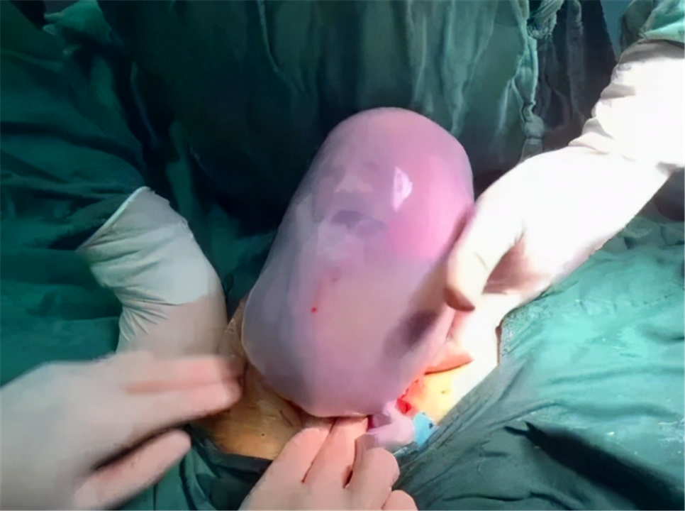 百萬分之一的概率！90後孕媽誕下「果凍寶寶」　陪產寶爸嚇得「不敢抱」醫生卻說：恭喜你 