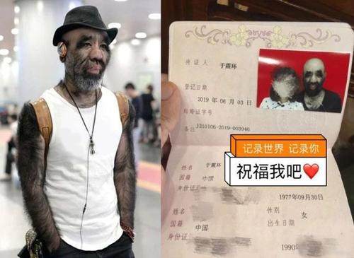 他一出生就被人研究！整日「只敢穿長袖」　逆風追夢活出自我「42歲娶90後嬌妻」羨煞眾人