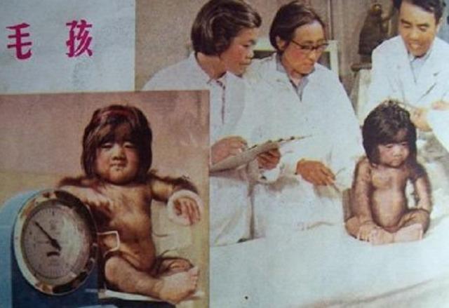 全身長滿毛！剛出生「就被科學家研究」　長大後「被人花1000萬包裝」42歲娶90後嬌妻