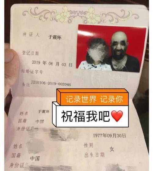 全身長滿毛！剛出生「就被科學家研究」　長大後「被人花1000萬包裝」42歲娶90後嬌妻