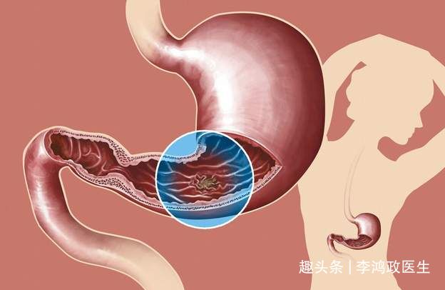 頭暈半年找不到原因！女子「臉色牙齦皆蒼白」以為貧血　檢查結果「問題竟是在胃部」：小細節恐喪命