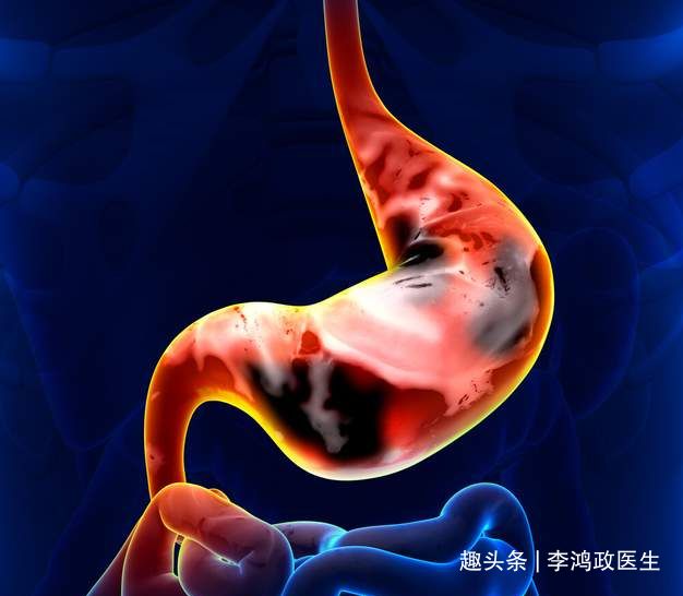 頭暈半年找不到原因！女子「臉色牙齦皆蒼白」以為貧血　檢查結果「問題竟是在胃部」：小細節恐喪命